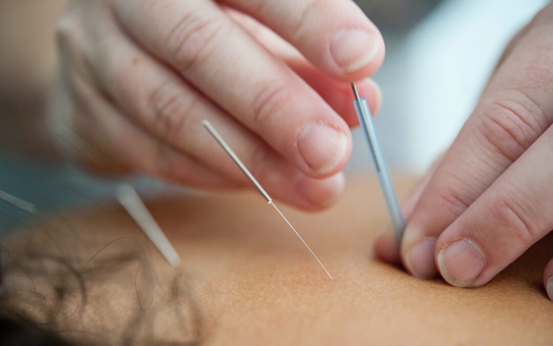 What is Acupuncture Good For?